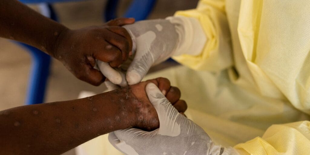 Mpox no Brasil: 88 casos notificados em 2026 e medidas essenciais de prevenção Mpox no Brasil: 88 casos notificados em 2026 e medidas essenciais de prevenção