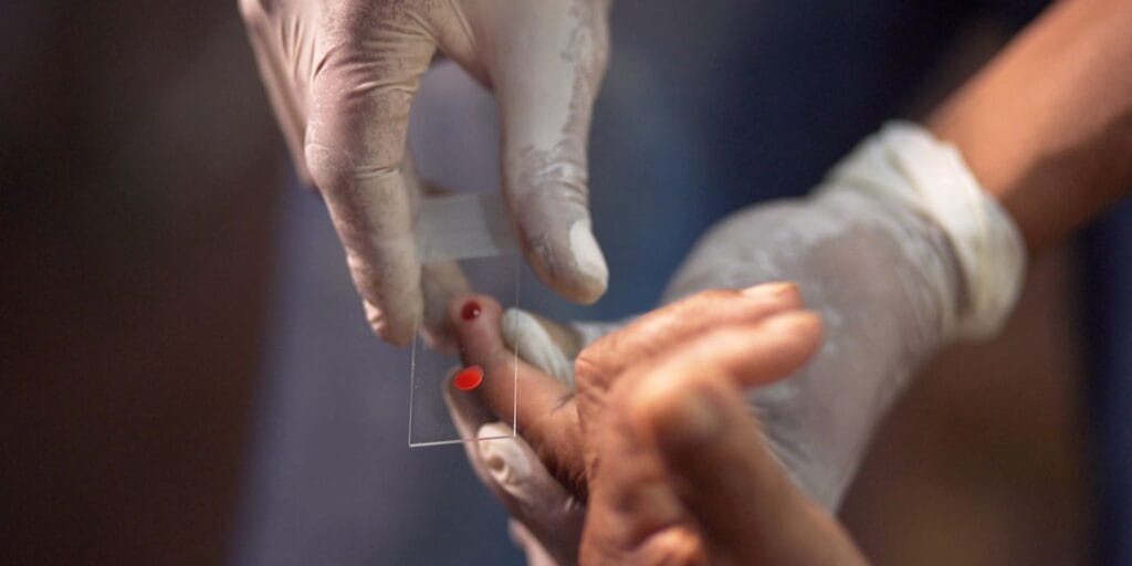 SUS inicia novo tratamento pediátrico contra a malária para crianças SUS inicia novo tratamento pediátrico contra a malária para crianças