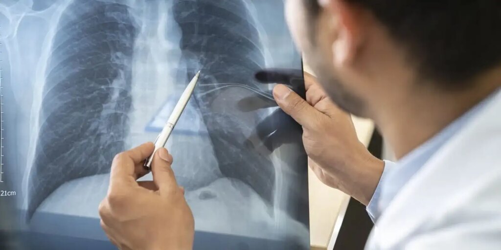 Jovens de 16 a 24 anos apresentam maior incidência de tabagismo, revela pesquisa estagios-cancer-de-pulmao
