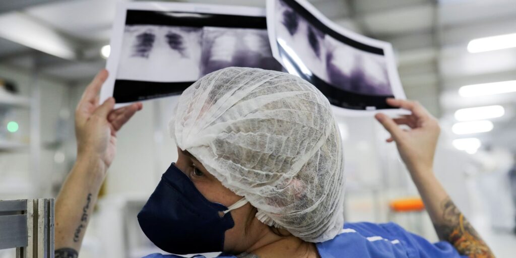 Câncer de pulmão: o impacto do diagnóstico tardio nas chances de cura radiografia_de_torax_coronaviruscovid-19_hospital_sao_paulo1205200325