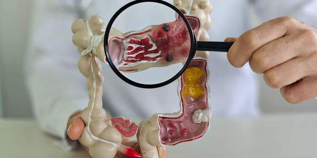 Doença inflamatória intestinal cresce cinco vezes em 13 anos no Brasil: um alerta à saúde pública adobestock_1773729270